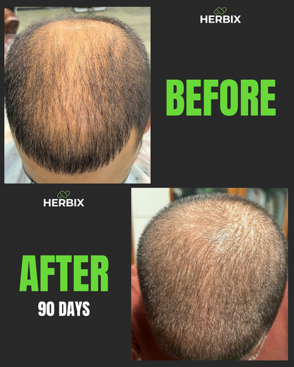 DHT Blocker (Hairloss)